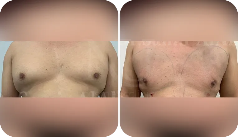 gynaecomastia surgery patient before and after result-6