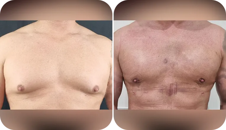 gynecomastia liposuction patient before and after result-1
