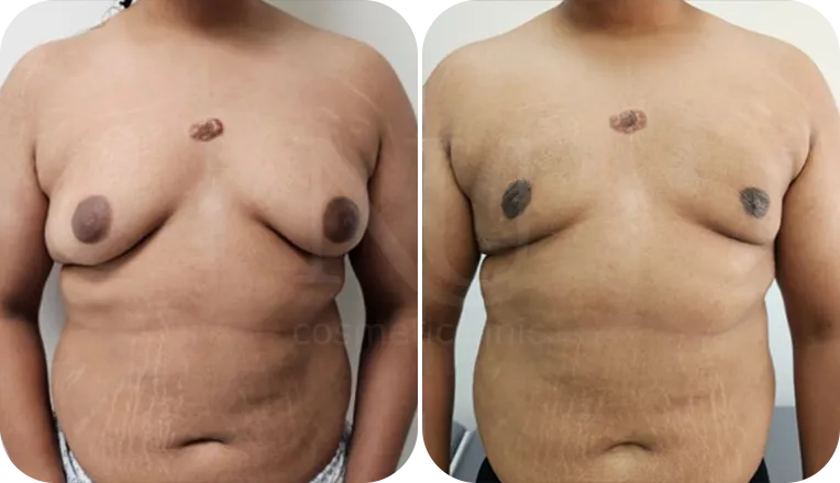 gynecomastia liposuction patient before and after result-2