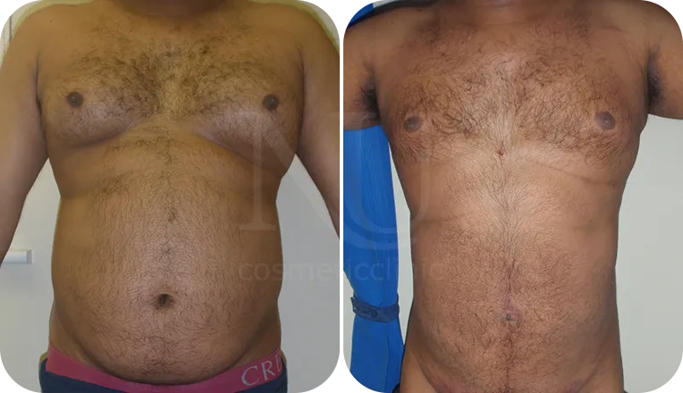 gynecomastia liposuction patient before and after result-3