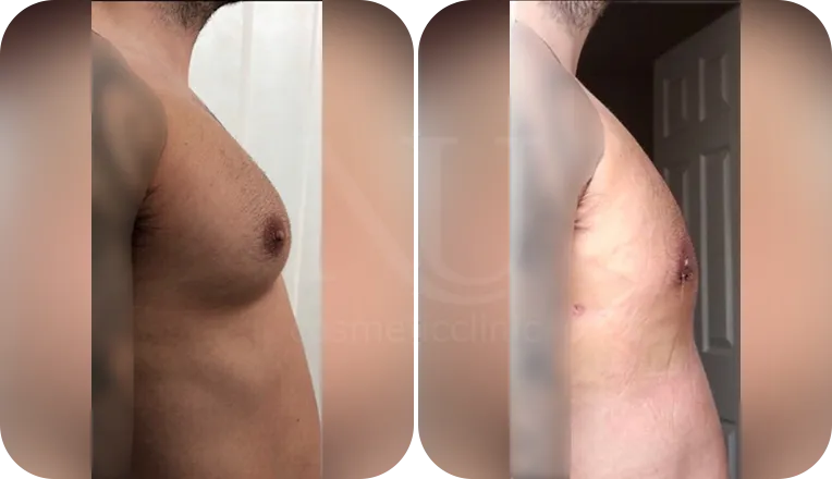 gynecomastia liposuction patient before and after result-4