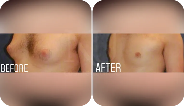 gynecomastia liposuction patient before and after result-5