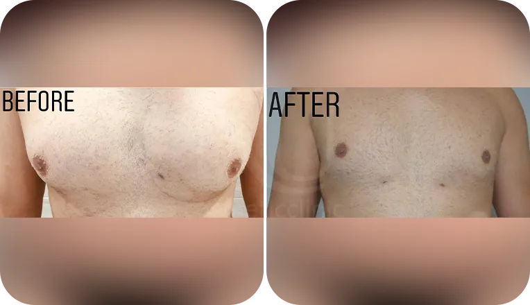 gynecomastia liposuction patient before and after result-6