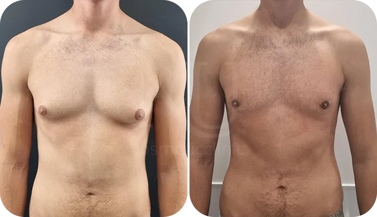 gynecomastia liposuction patient before and after result