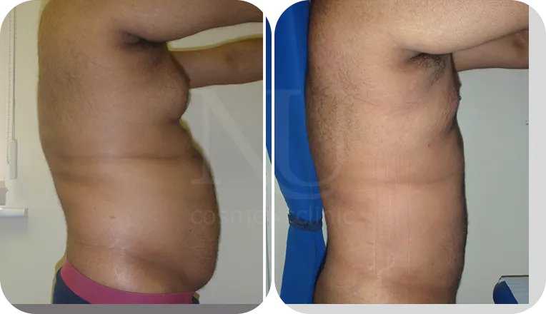 gynecomastia patient before and after result-1-v1