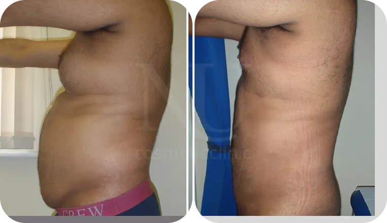 gynecomastia patient before and after result-1-v2