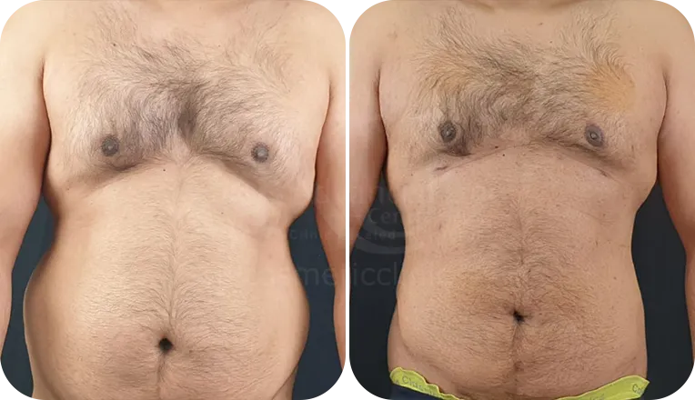 gynecomastia patient before and after result-2-v1