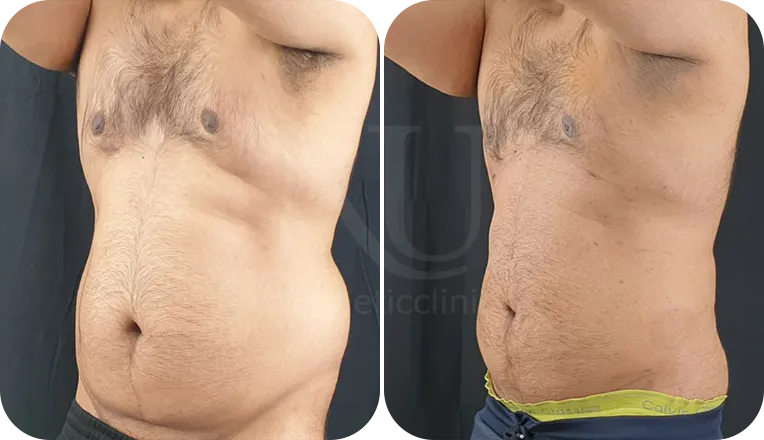 gynecomastia patient before and after result-2-v3