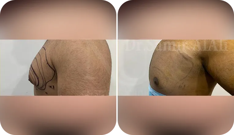 gynecomastia patient before and after result-3-v1