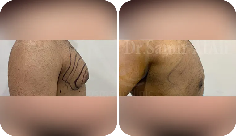 gynecomastia patient before and after result-3-v2
