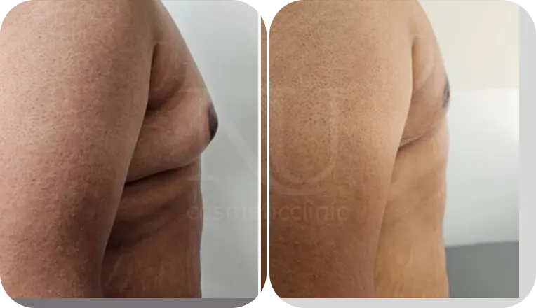 gynecomastia patient before and after result-4-v1