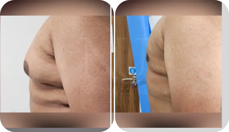 gynecomastia patient before and after result-4-v2
