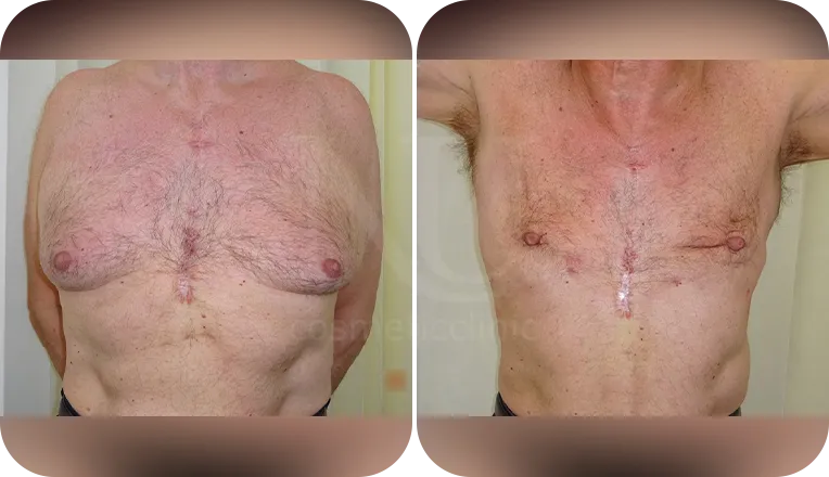 gynecomastia patient before and after result-5