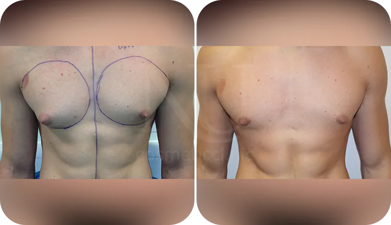 gynecomastia patient before and after result-6
