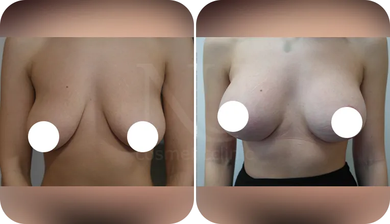 mastopexy augmentation patient before and after result-1-v1