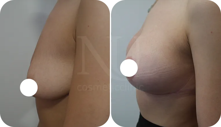 mastopexy augmentation patient before and after result-1-v2