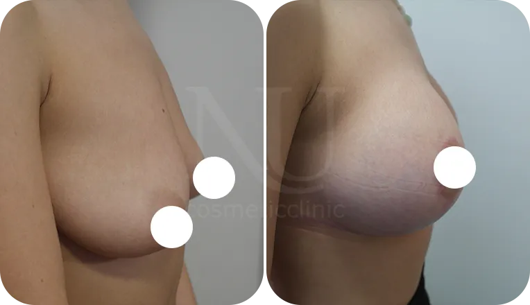 mastopexy augmentation patient before and after result-1-v3