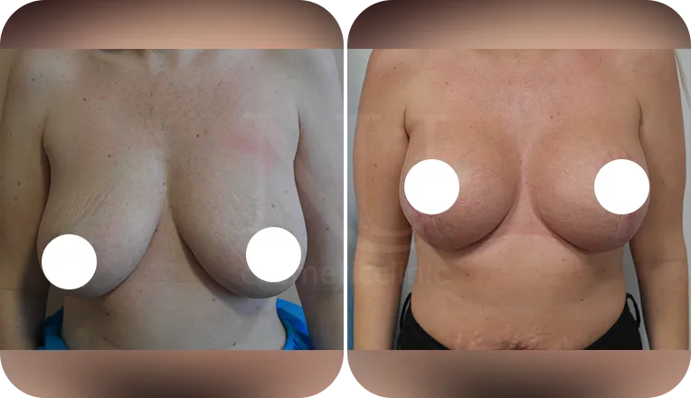 mastopexy augmentation patient before and after result-2-v1