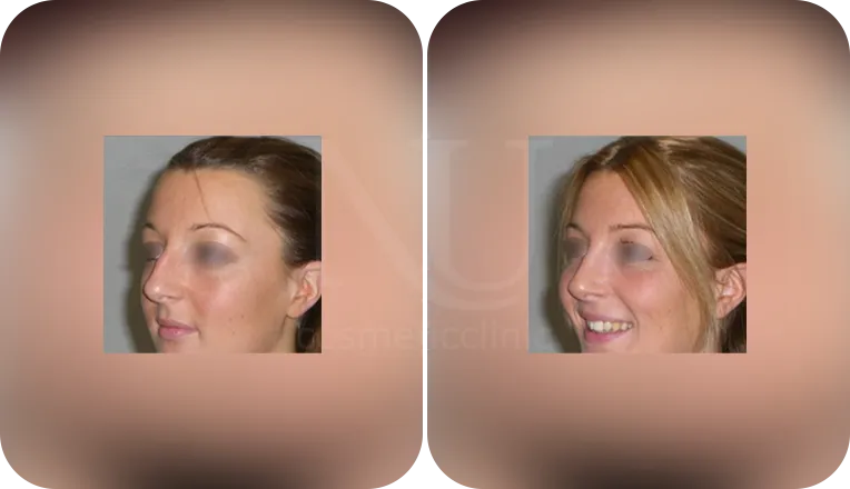 nose job patient before and after result-2
