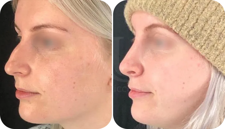 nose job patient before and after result-3
