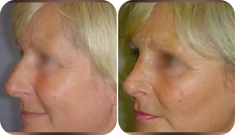 nose job patient before and after result