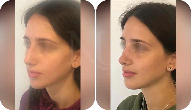 rhinoplasty patient before and after result-1