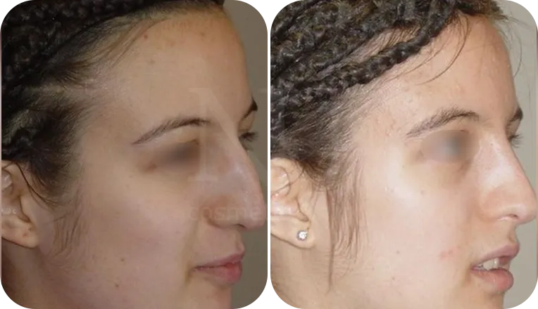 rhinoplasty patient before and after result-3