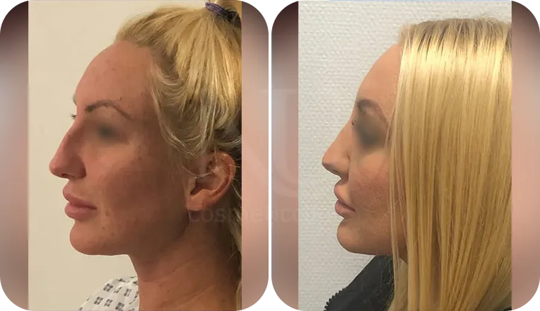 rhinoplasty patient before and after result