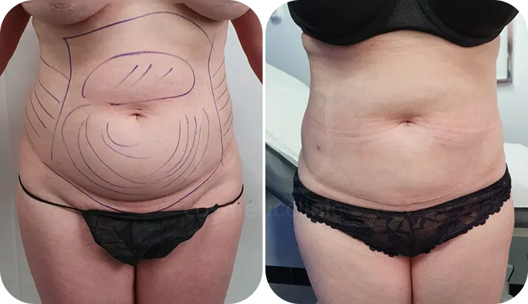 stomach vaser lipo patient before and after result-1