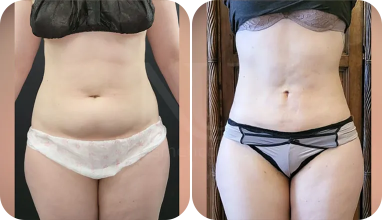 stomach vaser lipo patient before and after result-2
