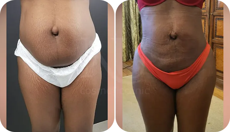 stomach vaser lipo patient before and after result-3