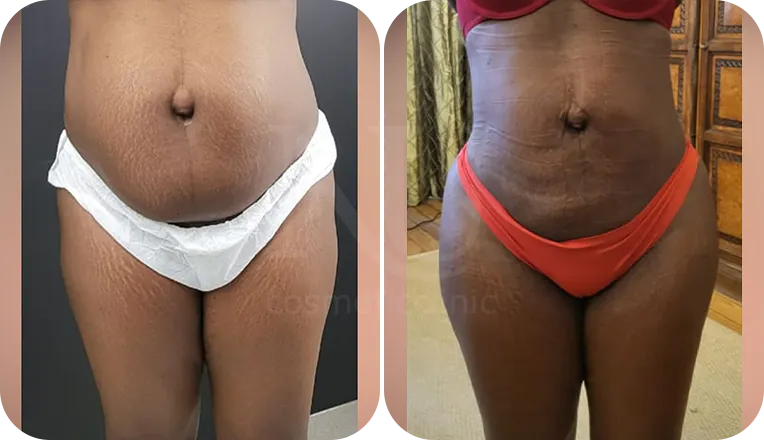 Vaser Liposuction for Lipedema Treatment - Welfare Abroad