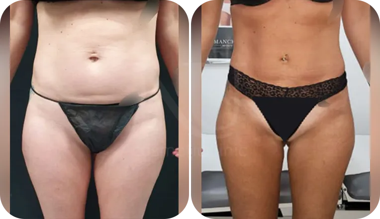 stomach vaser lipo patient before and after result-4