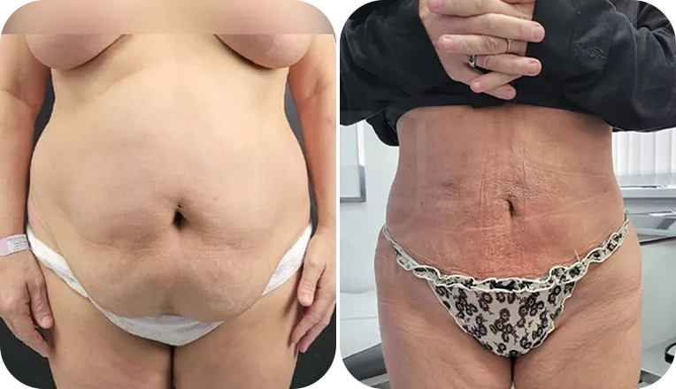 stomach vaser lipo patient before and after result