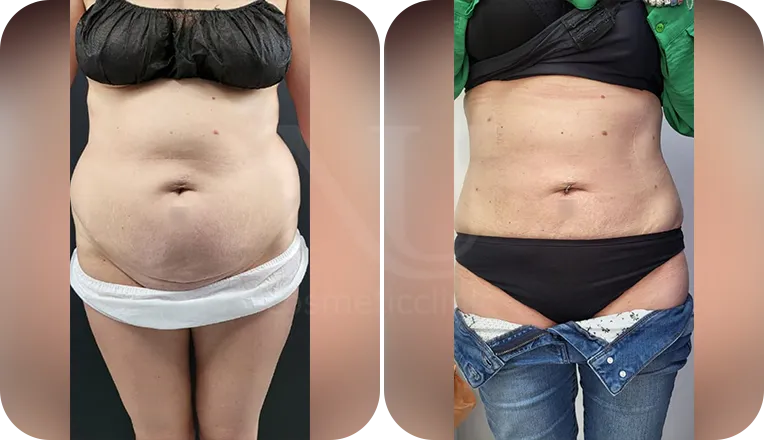 stomach vaser liposuction patient before and after result-1