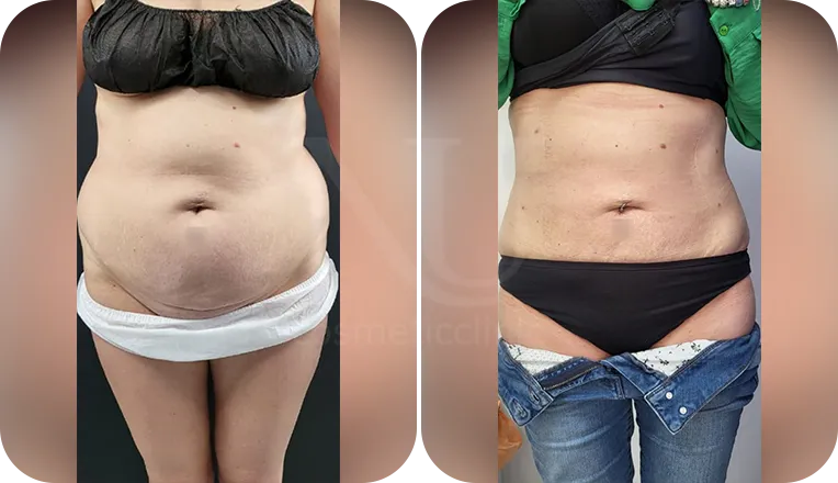 Vaser Liposuction for Lipedema Treatment - Welfare Abroad