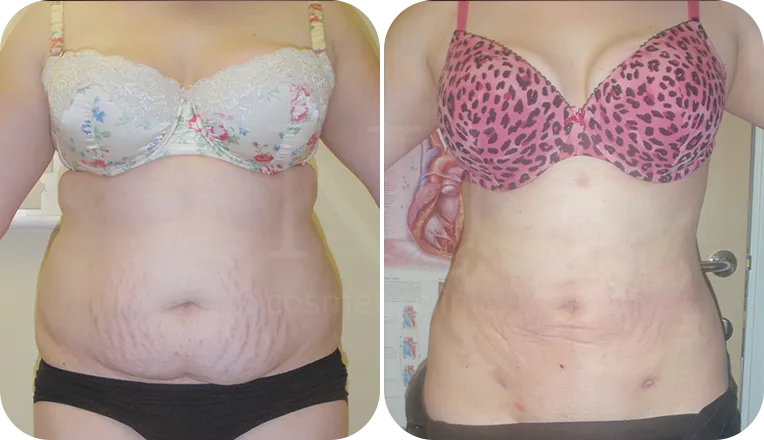 stomach vaser liposuction patient before and after result-2