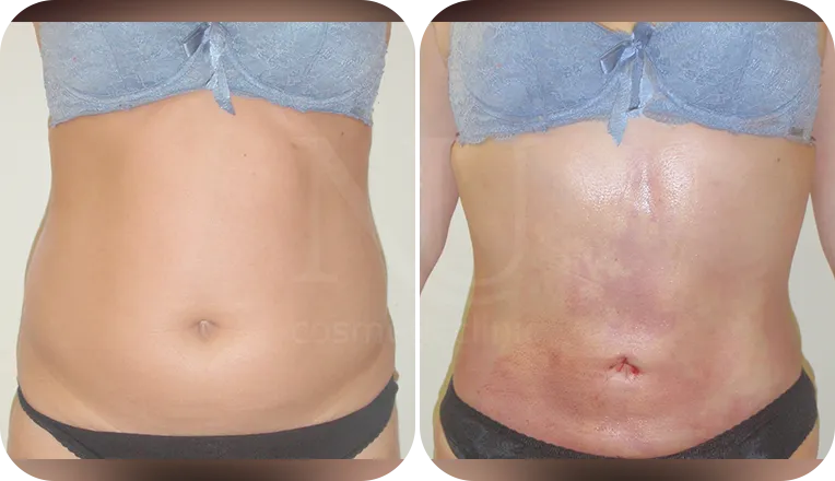stomach vaser liposuction patient before and after result-3