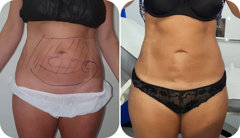 stomach vaser liposuction patient before and after result
