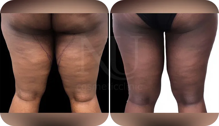 thigh liposuction patient before and after result-1-v1