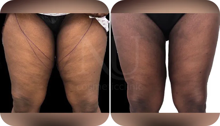 thigh liposuction patient before and after result-1-v2