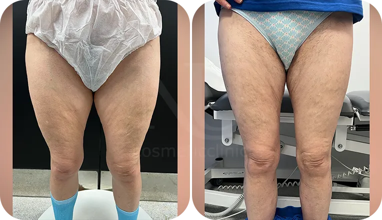 thigh liposuction patient before and after result-4