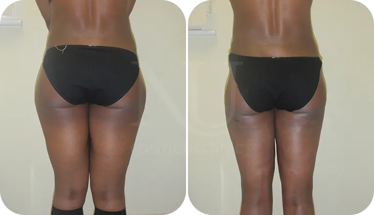 thigh vaser liposuction patient before and after result-1-v1