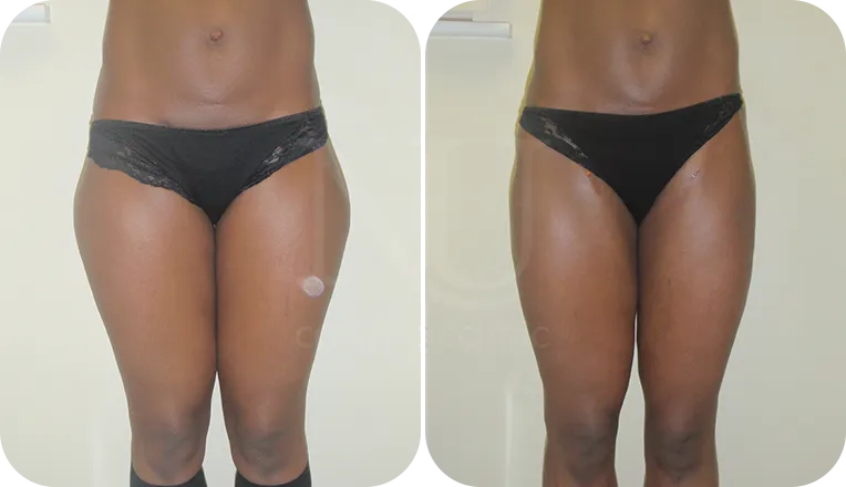 thigh vaser liposuction patient before and after result-1-v2