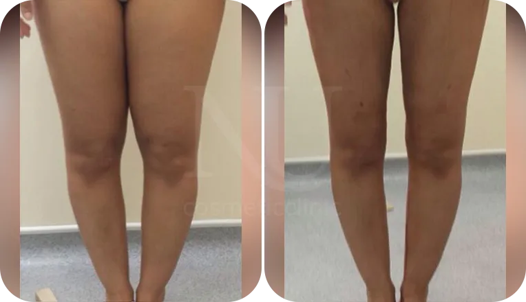 thigh vaser liposuction patient before and after result-2-v1