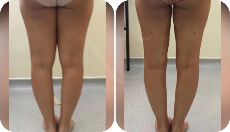 thigh vaser liposuction patient before and after result-2-v2