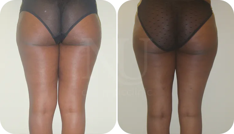 thigh vaser liposuction patient before and after result-3-v1
