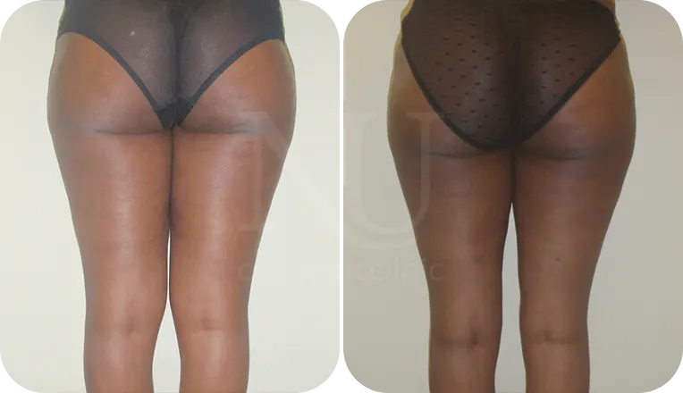 Thigh Lift London, Thigh Reduction Surgery UK