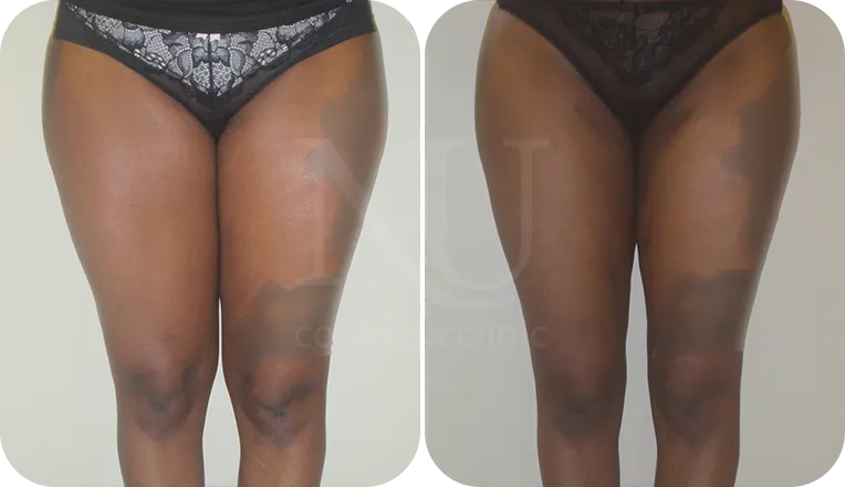 thigh vaser liposuction patient before and after result-3-v2