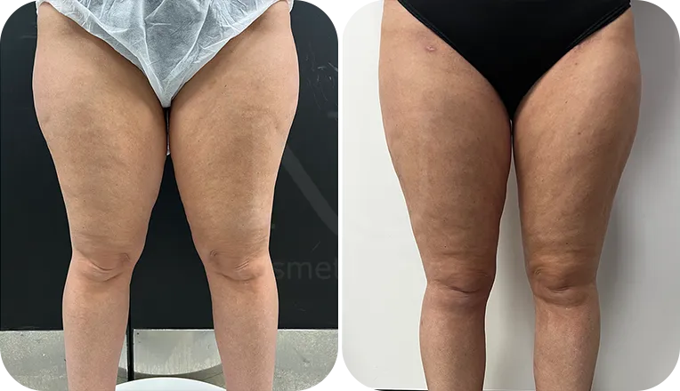 thigh vaser liposuction patient before and after result-4